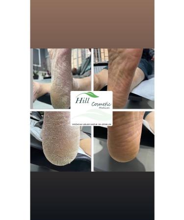 hillfoot Hill Cosmetic General Foot Care and Heel Cream (Callus and Heel Crack ) Podiatry - Buy Online on GoSupps.com