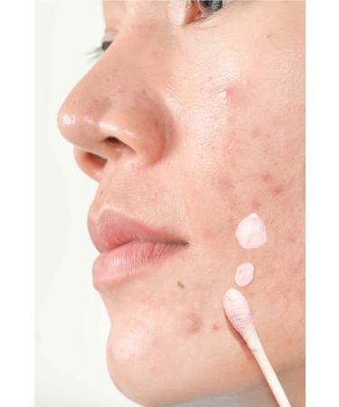 Luv it! Anti-Acne Lotion 30 Ml - Buy Online on GoSupps.com