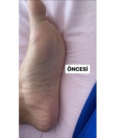 HODAF 1 Pair Sock Type Peelable Lemon Flavored Foot Peeling Mask for Dead Skin and Cracks - Buy Online on GoSupps.com