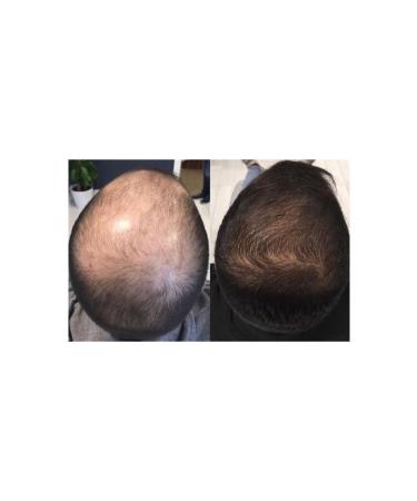 Borkaon Hairon Plus Blue Serum (1 Piece) - Buy Online on GoSupps.com