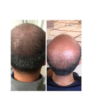 Blue Serum Hair Serum Blue Lotion Hairon Plus - Buy Online on GoSupps.com