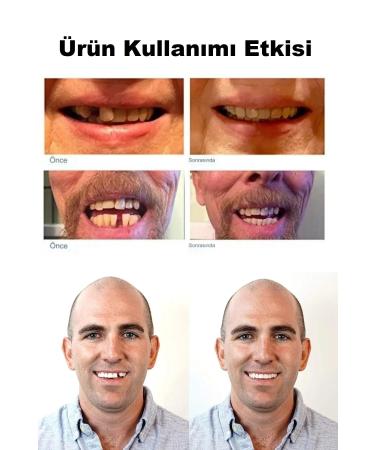 qualityworld Teeth Repair Kit Missing Teeth Repair Kit Perfect Oral Care Smile Smile With Confidence - Buy Online on GoSupps.com