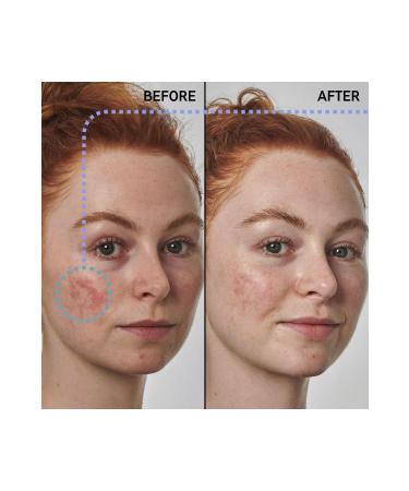 THE INKEY LIST Redness Solution with 10% Azelaic - Face Serum - 30 ml - Buy Online on GoSupps.com