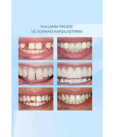 qualityworld Teeth Repair Kit Missing Teeth Repair Kit Perfect Oral Care Smile Smile With Confidence - Buy Online on GoSupps.com