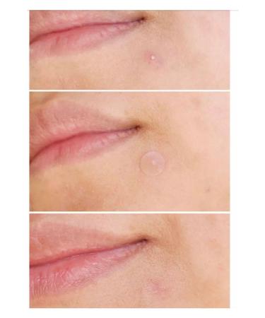 JEJUDO Ceuticals Original Pimple Patch 36 Patch - Acne and Pimple Patch - Buy Online on GoSupps.com