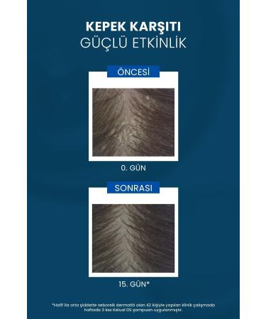 Ducray Kelual DS Shampoo Stubborn and Severe Anti-Dandruff Shampoo 100ml - Buy Online on GoSupps.com