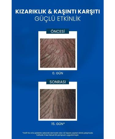 Ducray Kelual DS Shampoo Stubborn and Severe Anti-Dandruff Shampoo 100ml - Buy Online on GoSupps.com