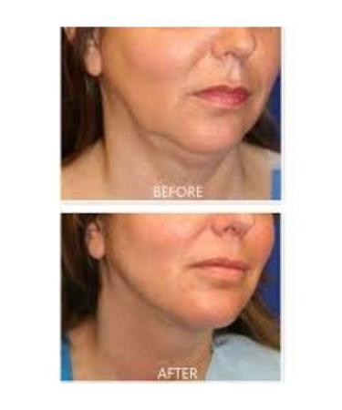 DR Lipo Mesotherapy Double Chin Melting Cheek Thinning Price is for 1 Vial (INJECTORS AND ANESTHESIA CREAM) - Buy Online on GoSupps.com