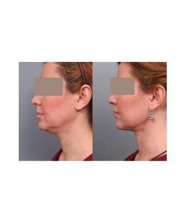 DR Lipo Mesotherapy Double Chin Melting Cheek Thinning Price is for 1 Vial (INJECTORS AND ANESTHESIA CREAM) - Buy Online on GoSupps.com