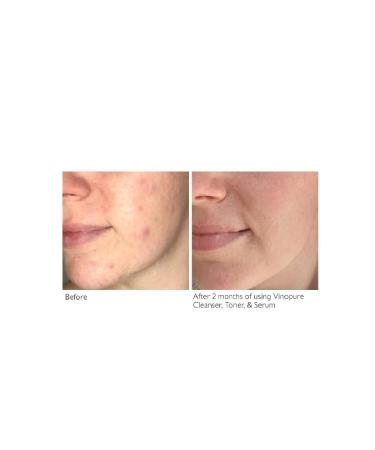 Caudalie V NOPURE ANTI-ACNE PORE CONCEALER REVIVAL SERUM-30ML PASS .1787 - Buy Online on GoSupps.com