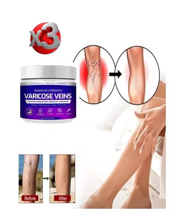 TAMNET Maximum Strength Varicose Veins Care Cream 100 ml x 3 pieces