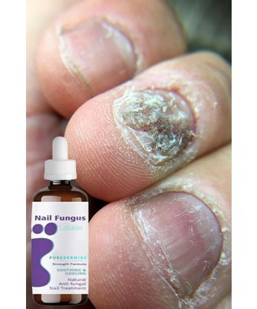 Puredermine Herbal Lotion & Effective Solution & Fungus & Broken Nails & Hand & Foot Care - Buy Online on GoSupps.com