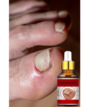Puredermine Nail Fungus Deep Treatment Essence & Herbal Formula & Hand & Foot Treatment - Buy Online on GoSupps.com