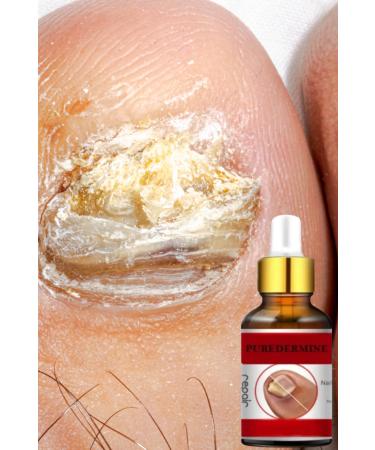 Puredermine Nail Fungus Deep Treatment Essence & Herbal Formula & Hand & Foot Treatment - Buy Online on GoSupps.com