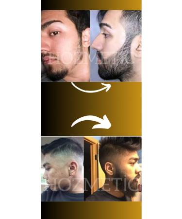 HOZMETIC Supports New Beard Formation for Sparse Beard and Beardlessness Problem Beard & Moustache Serum - Buy Online on GoSupps.com