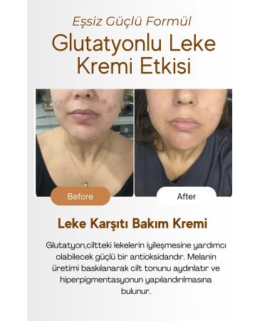 Roen Skin Whitening Blemish Cream Darkening Acne Sun Spots Glutathione Whitening Blemish Cream 50ml - Buy Online on GoSupps.com