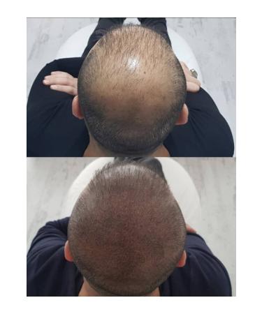 Hera Golden Ratio Dr. Scalp Hair Simulation Dye 20ml (MEDIUM BROWN) - Buy Online on GoSupps.com