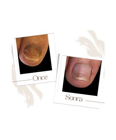 Fungalex Foot and Nail Care Spray 2-Pack Advantageous Package - Buy Online on GoSupps.com