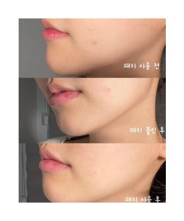 Troubleless SOS CLEAR GEL CREAM+ INVISABLE SPOT PATCH 96 PACK ACNE TAPE - Buy Online on GoSupps.com