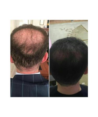 Purexpose Hair and Thickening Serum Lotion 1 Piece - Buy Online on GoSupps.com