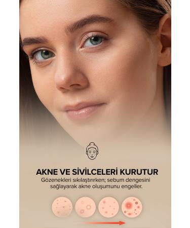 Q Lune Acne Drying Lotion / Pore Tightening Lotion 30 Ml (ANTI ACNE CARE LOSION) - Buy Online on GoSupps.com