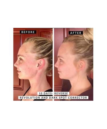 Revolution Skincare Dark Spot Corrector Effective Serum Against Black Spots and Dots 30 Ml - Buy Online on GoSupps.com