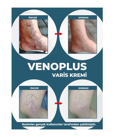 DermoNem Venoplus Cream - Buy Online on GoSupps.com