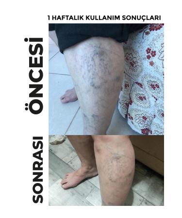 DermoNem Venoplus Cream - Buy Online on GoSupps.com