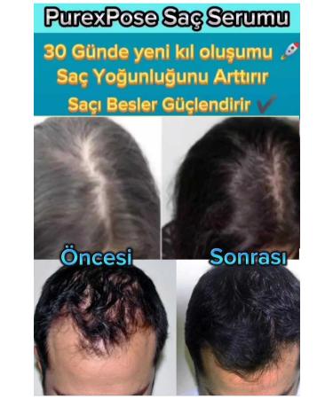 Purexpose Men&Women Hair Care Serum and Hair Growth Aid Serum 1 Piece - Buy Online on GoSupps.com