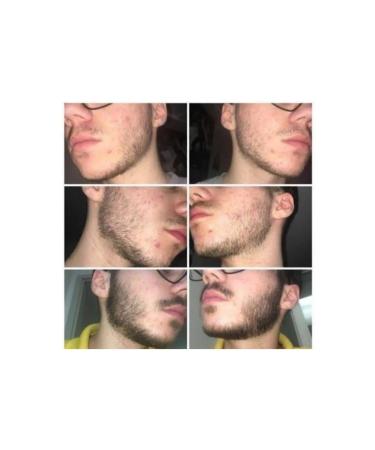 Purexpose Beard Growth Serum & Moustache Care Serum - Nourishes and Strengthens the Beard & 1 Dermaroller - Buy Online on GoSupps.com