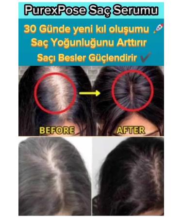 Purexpose Hair Care Men&Women Hair Growth Aid Hair Lotion 5pcs Dermaroller Gift - Buy Online on GoSupps.com