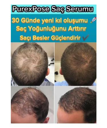 Purexpose Hair Care Serum - Hair Growth Helping Hair Growth Hair Growth Hair Lotion 1 piece - Buy Online on GoSupps.com