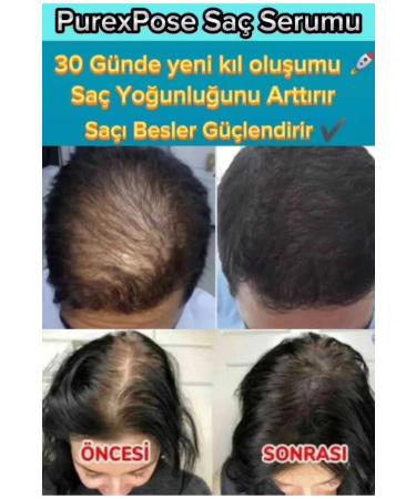 Purexpose Hair Care Nourishing Strengthening Hair Growth Aid Lotion 1 Dermaroller - Buy Online on GoSupps.com