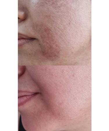 GULU NL NL Night Blemish Serum Formulated with 0 Pure Herbal Oils 40 ml - Buy Online on GoSupps.com