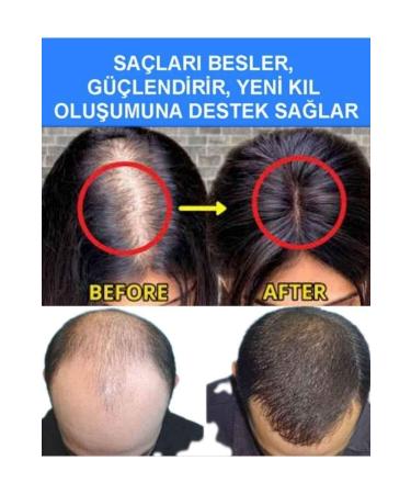 Blue Serum 2 Pieces Hair Care Nourishing Strengthening Hair Growth Lotion 1 Dermaroller Gift - Buy Online on GoSupps.com