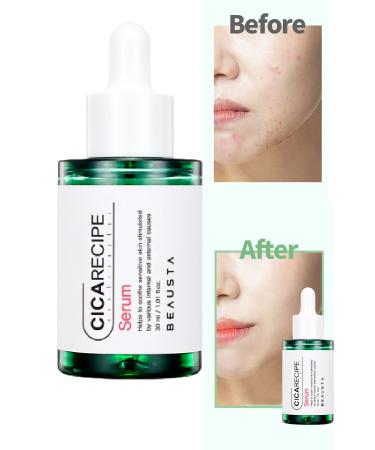 BEAUSTA Soothing Anti-Acne Serum with Cica Centella for Sensitive Skin