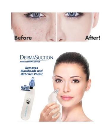 dermasuction Makeup Dermasuction 40kpa Vacuum Blackhead and Acne Removal Device