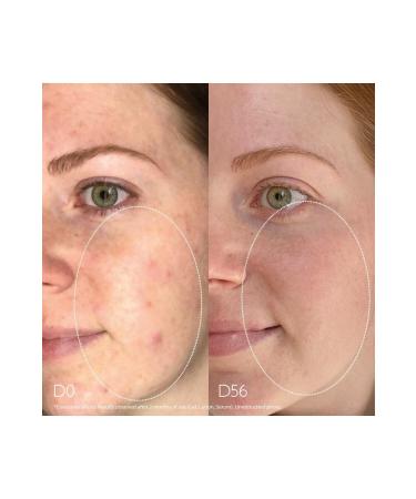 Caudalie Vinopure Anti-Acne and Anti-Blackhead Salicylic Serum for Sensitive Skin 30ml PSSNS184 - Buy Online on GoSupps.com