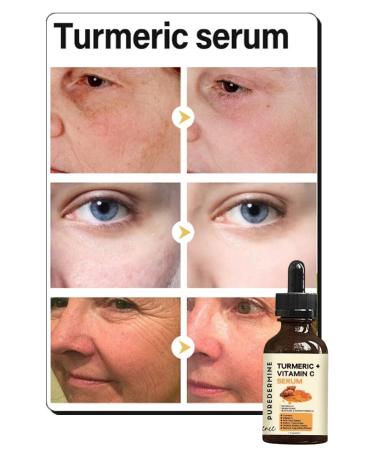 Puredermine Powerful Whitening Turmeric Serum Dark Spots & Acne & Melasma & Dark Joints & Fingers Knees & Elbows