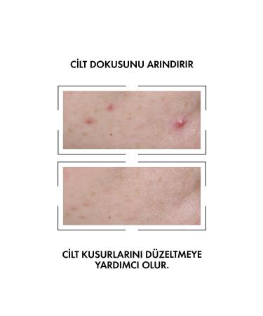 Vichy Normaderm Anti-Stain Serum 30 ml + Normaderm Phytosolution Purifying Gel 50ml.Set - Buy Online on GoSupps.com