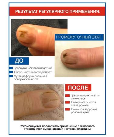 NANO-HEELS From the fungus of nails on the legs and hands of serum and monard - Buy Online on GoSupps.com