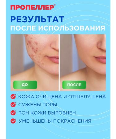 PROPELLER Salicylic skewers for combined skin - Buy Online on GoSupps.com