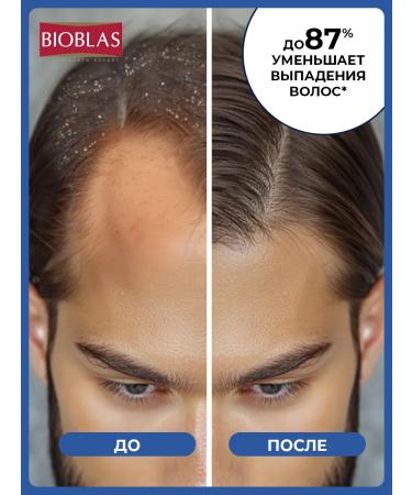 BIOBLAS Shampoo from male dandruff against falling out - Buy Online on GoSupps.com
