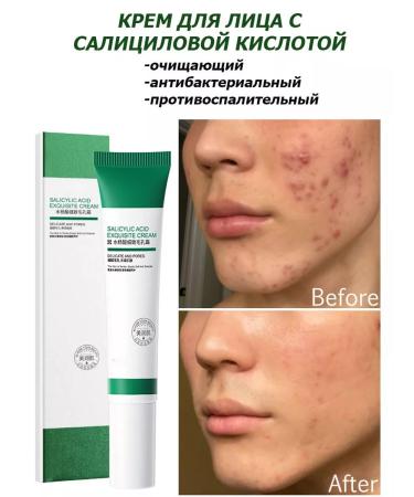 VEZE Facial cream from acne and acne with salicylic acid