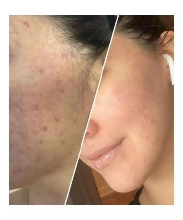 Gangster Acne chatterbox and acne for face salicylic 250 ml - Buy Online on GoSupps.com