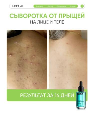 Lefami Permis from acne and black dots for skin and body skin