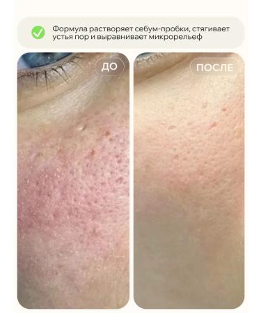 KEYCLEAR Serum for narrowing pores - Buy Online on GoSupps.com