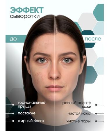 KEYCLEAR Facial serum from acne from black dots - Buy Online on GoSupps.com