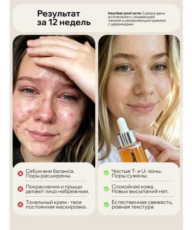 KEYCLEAR Facial serum from acne and black dots - Buy Online on GoSupps.com