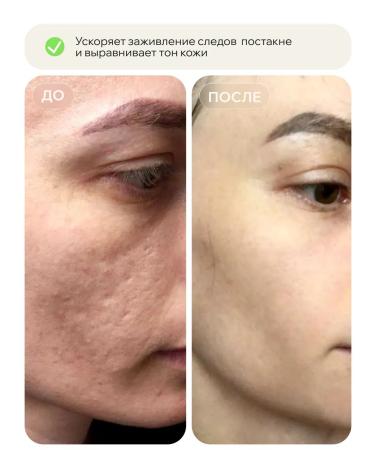 KEYCLEAR Facial serum from acne and black dots - Buy Online on GoSupps.com